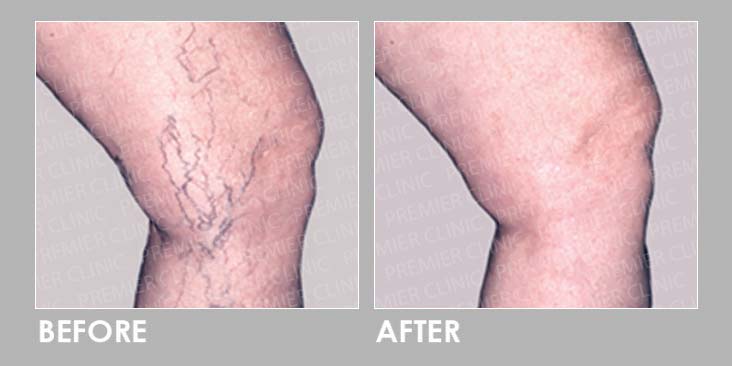 Sclerotherapy Injection Before After