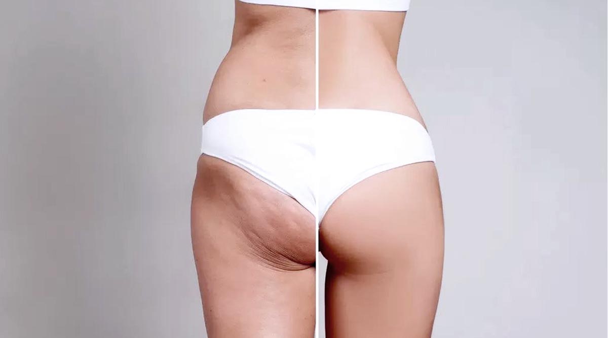 Shockwave Therapy