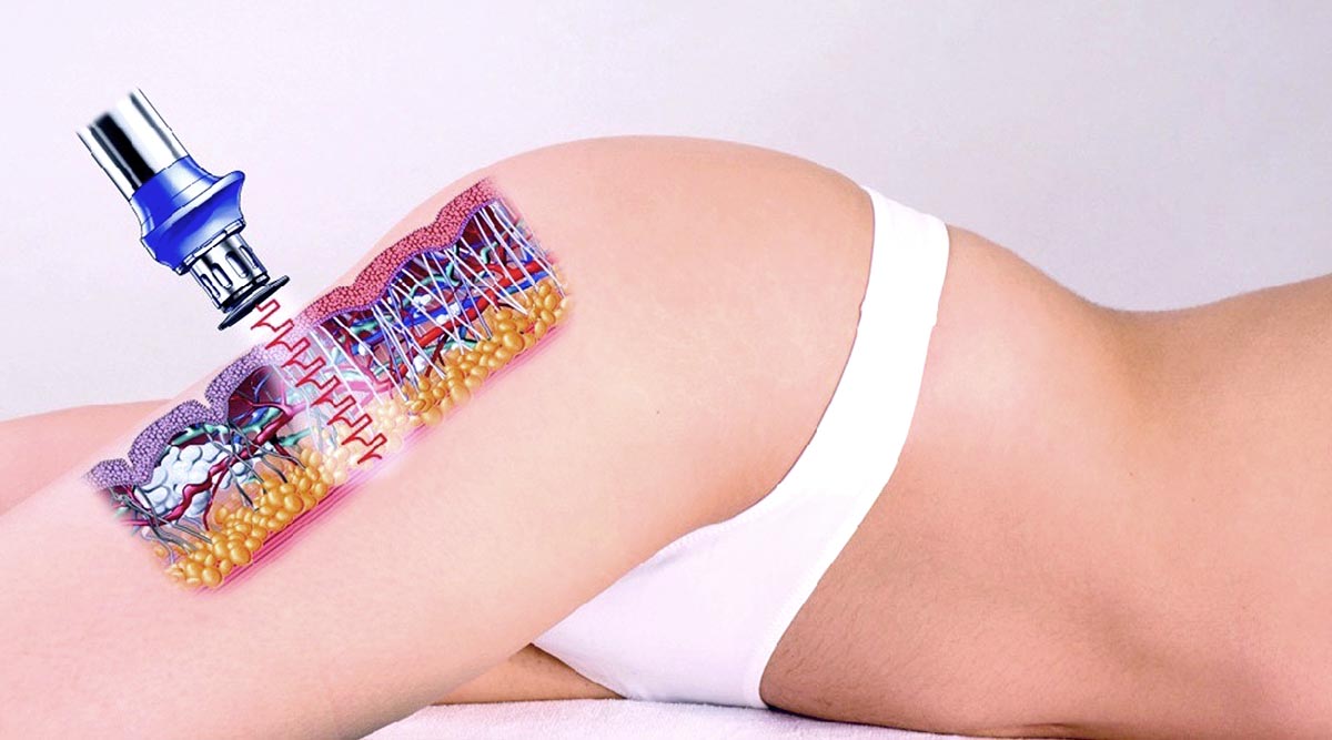 Shockwave Therapy