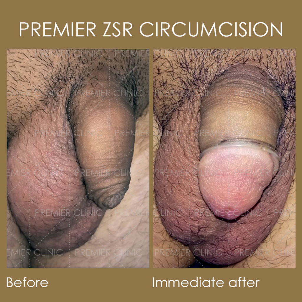 Premier ZSR Before & After