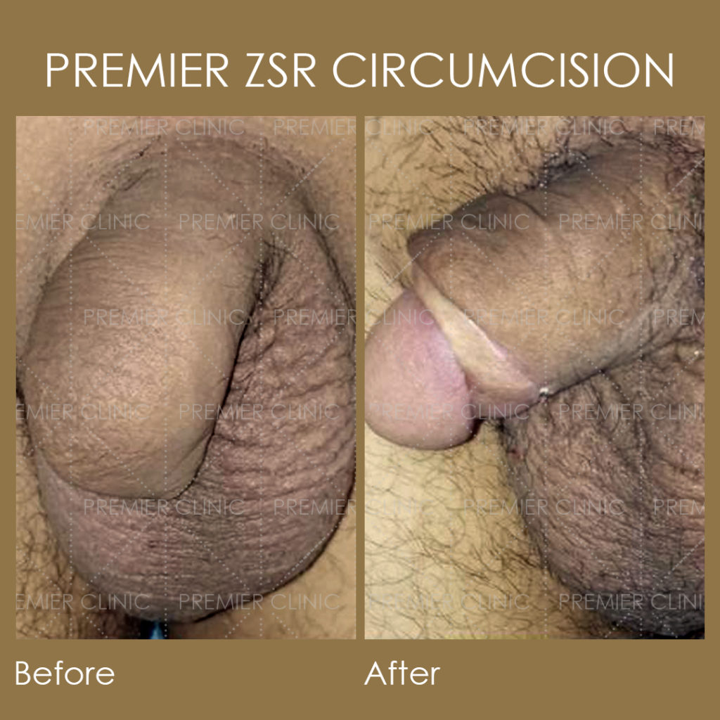 Premier ZSR Before & After