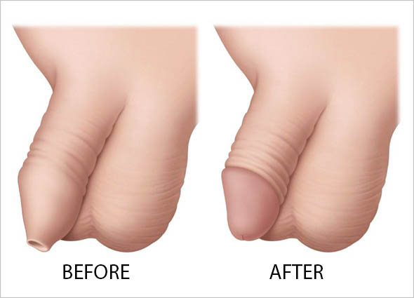 before & after ZSR Circumcision