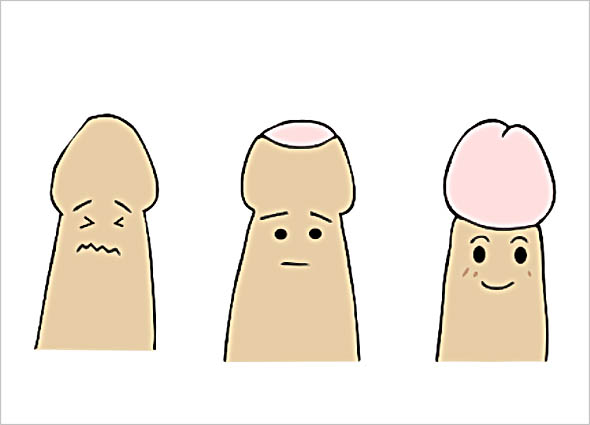 before & after ZSR Circumcision