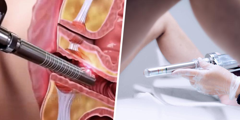 Laser Vagina Tightening
