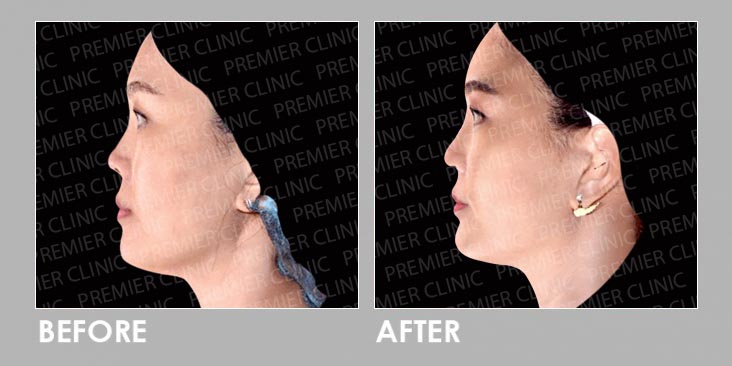 8cc Fillers Before & After