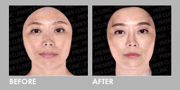 8cc Fillers Before & After