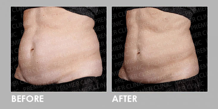 LipoFill Body Reshaping Before After