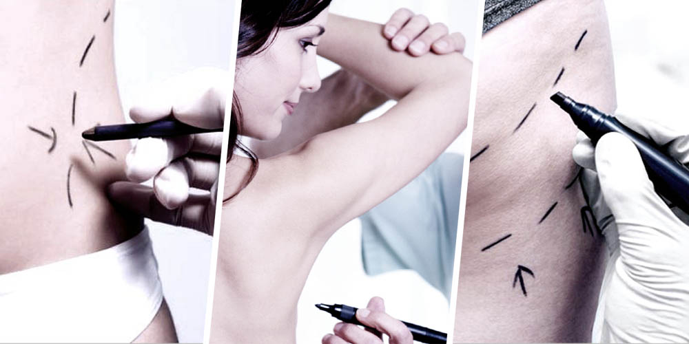 Lipocell Body Reshaping