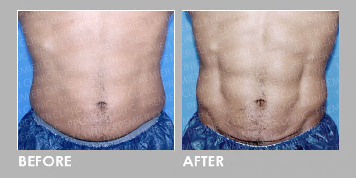 Premier Trusculpt - Muscle Stimulator Therapy