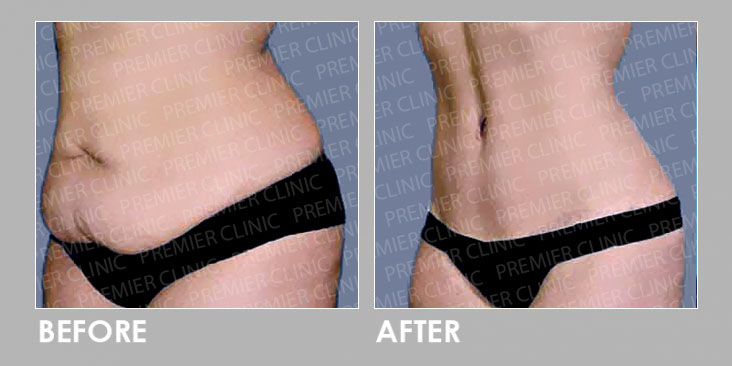 Premier Trusculpt - Muscle Stimulator Therapy