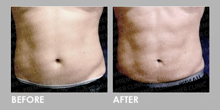Premier Trusculpt - Muscle Stimulator Therapy