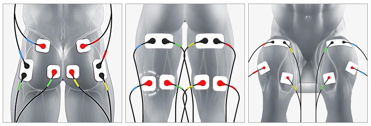 TRUSCULPT: THE ACE OF MUSCLE STIMULATOR THERAPY