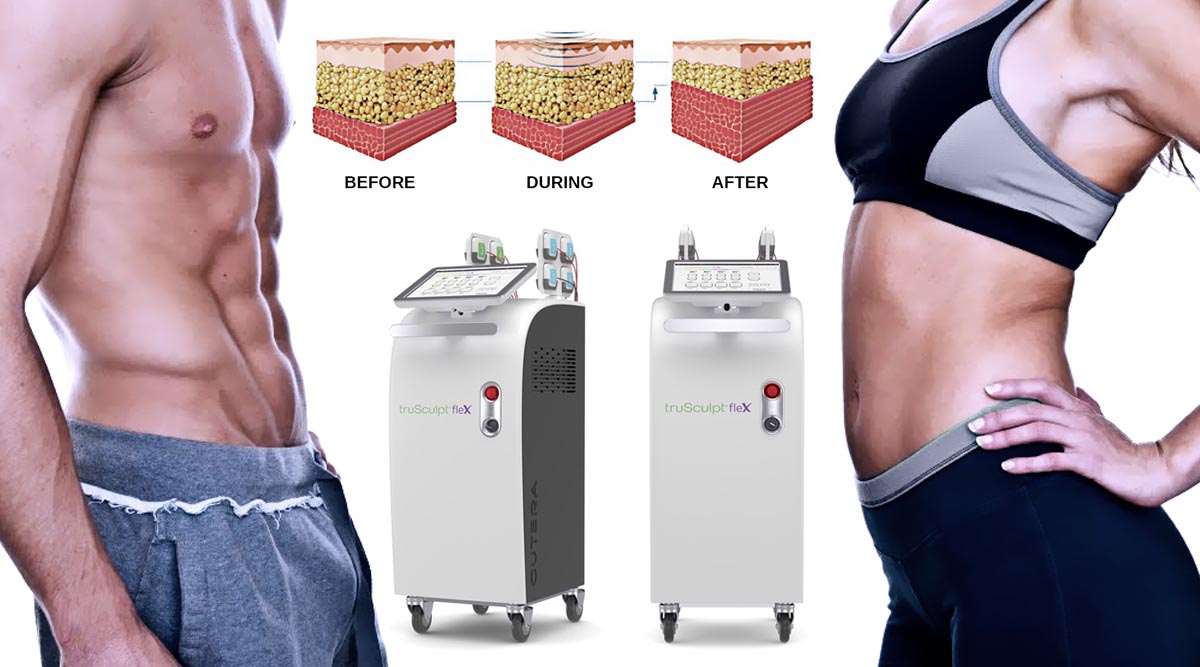 Trusculpt The Ace Of Muscle Stimulator Therapy 08