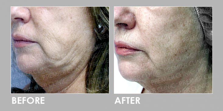 skin tightening & fat loss Before & After