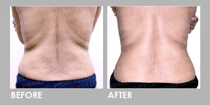 skin tightening & fat loss Before & After