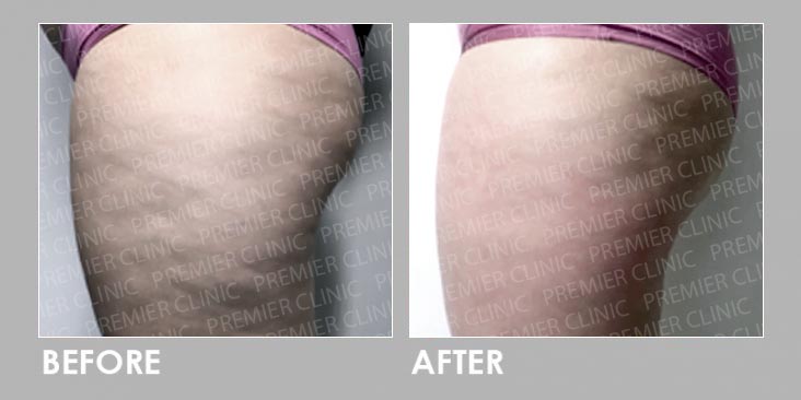 skin tightening & fat loss Before & After