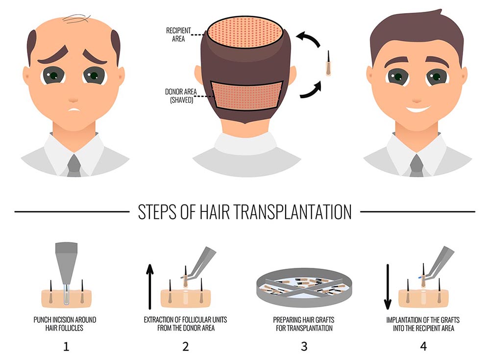 FUE Hair Transplant