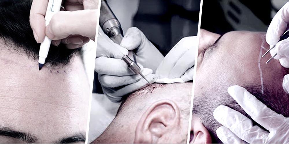 SureGrow Hair Transplant Promo