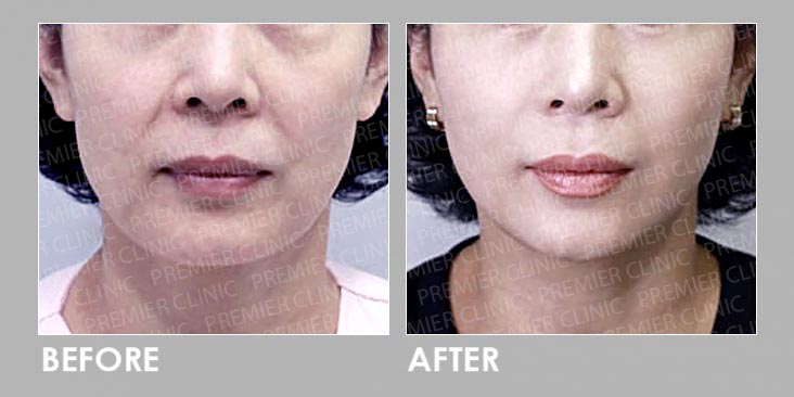 Ultherapy Before After