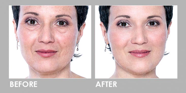 Dermal filler