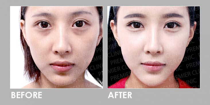 Dermal filler