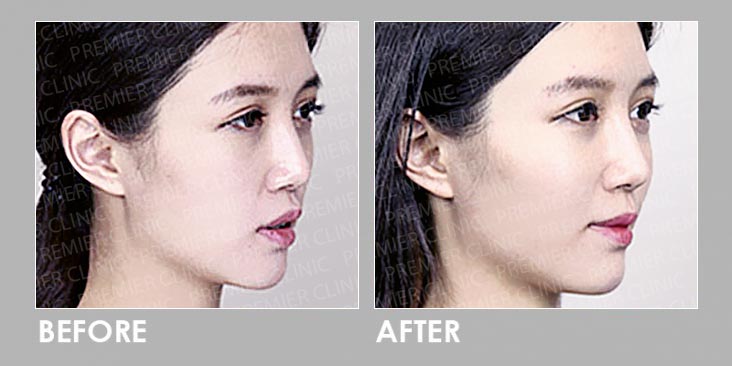Dermal filler