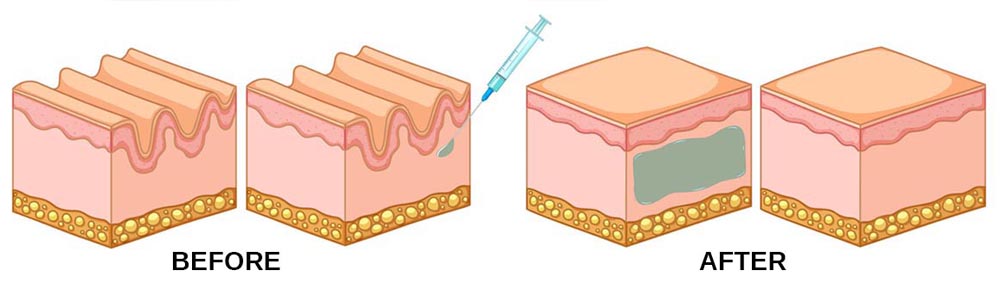 25% OFF FILLERS, Fill & Lift