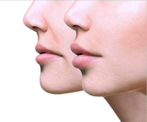 25% OFF FILLERS, Fill & Lift