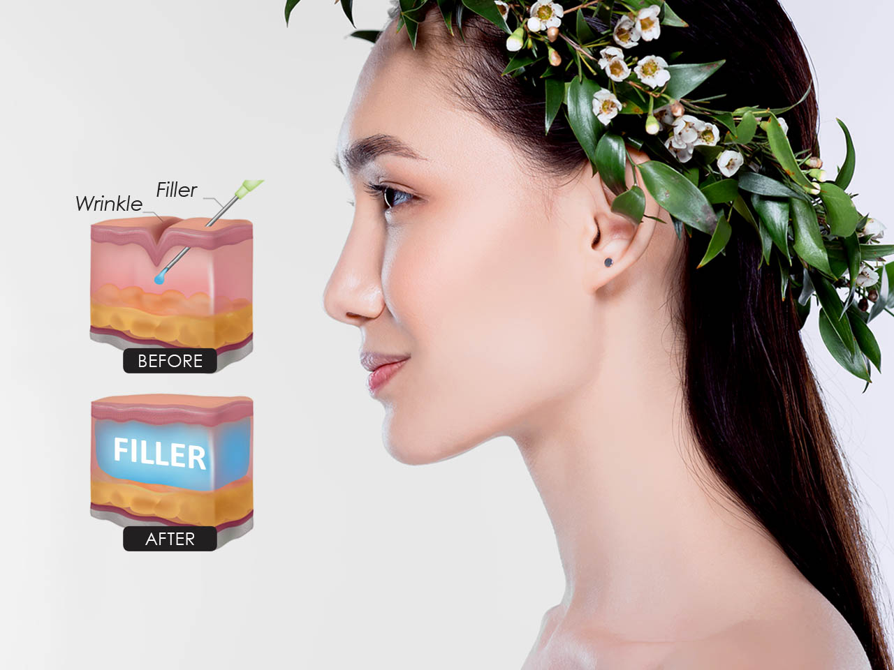 25% OFF FILLERS, Fill & Lift