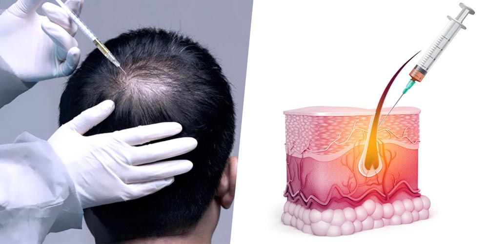 Premier Hair Loss Treatment - HAIR FIILLER