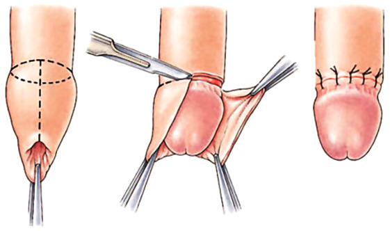 METHOD OF CIRCUMCISION