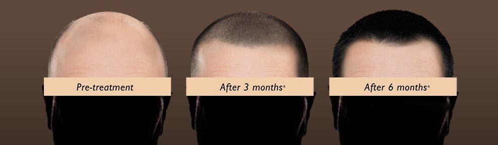 HAIR Transplant post care