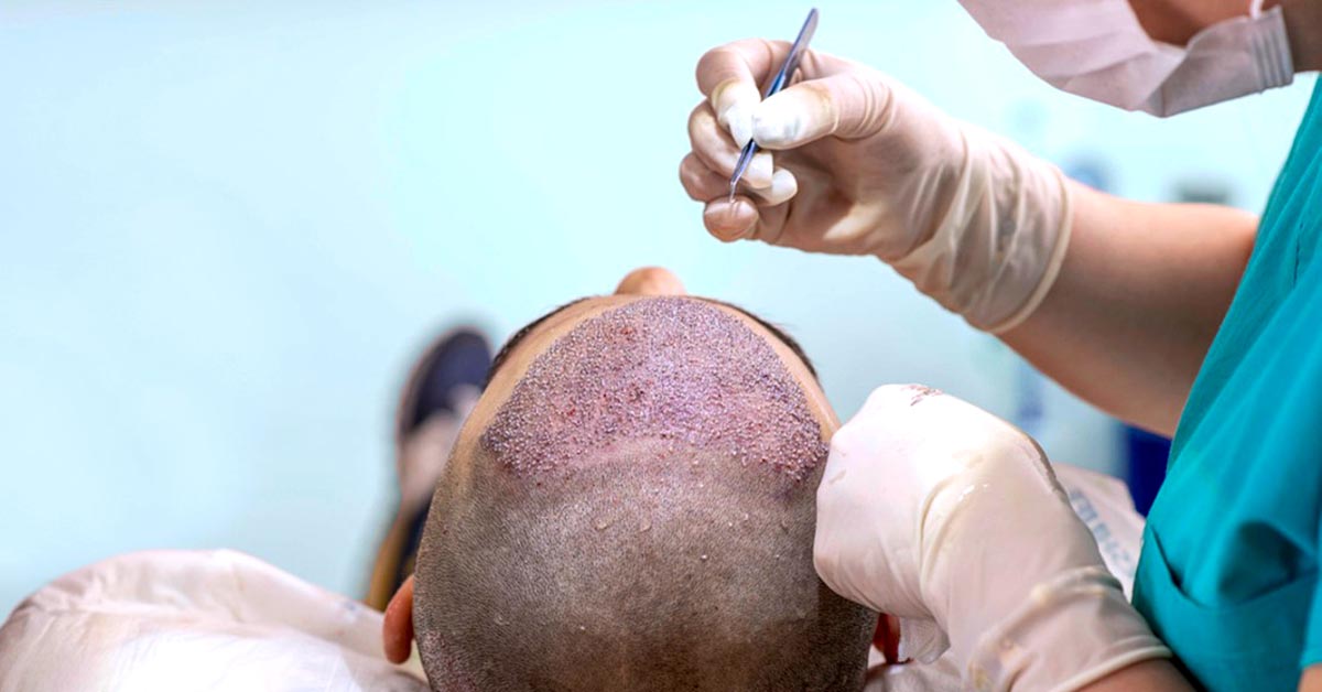 I did Hair Transplant For These 5 Benefits 