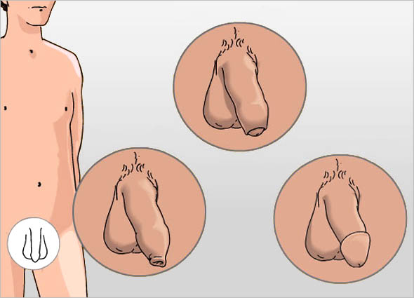 BENEFITS OF GETTING CIRCUMCISED
