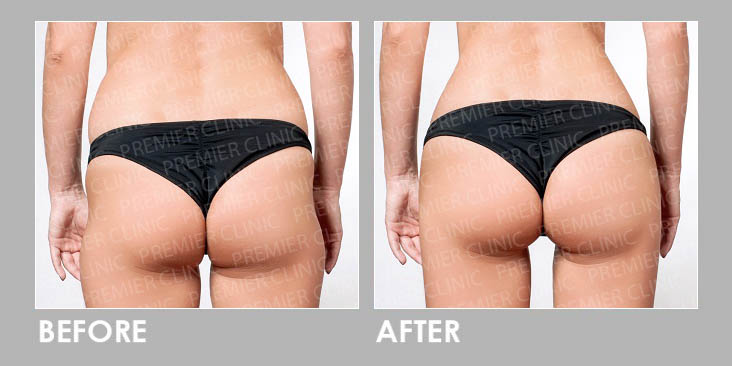 Trusculpt Flex Before & After