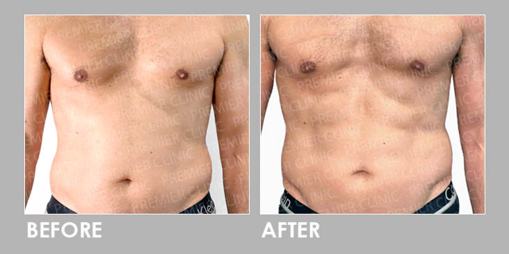 Trusculpt Flex Before & After