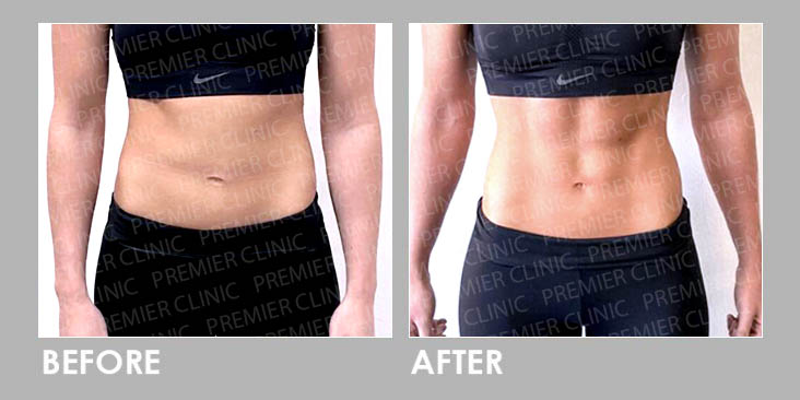 Trusculpt Flex Before & After