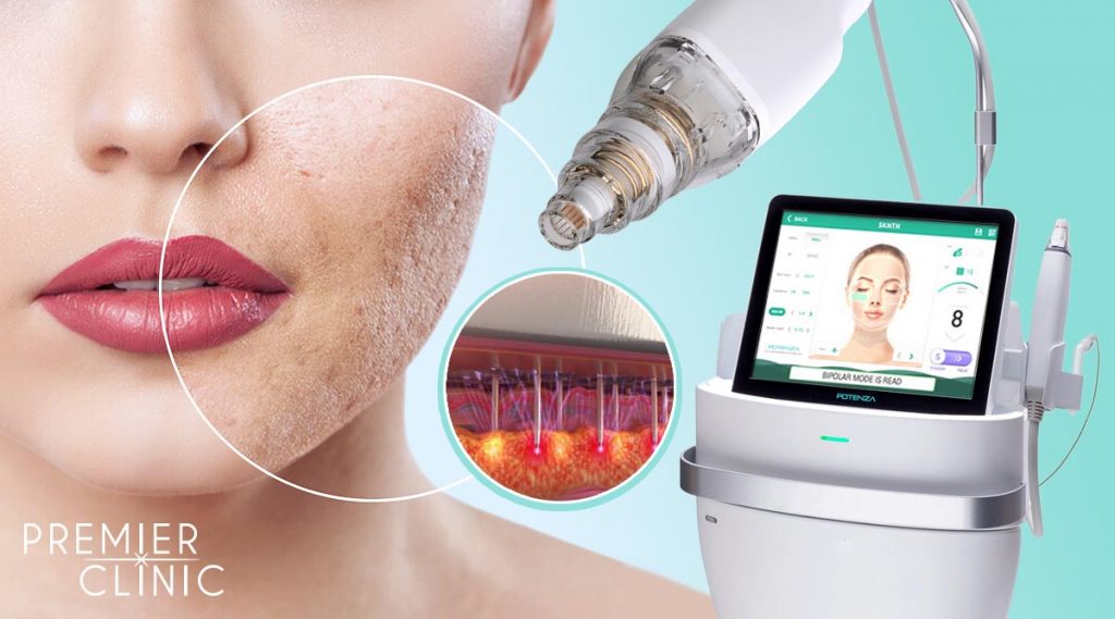 Potenza RF Micro-needling