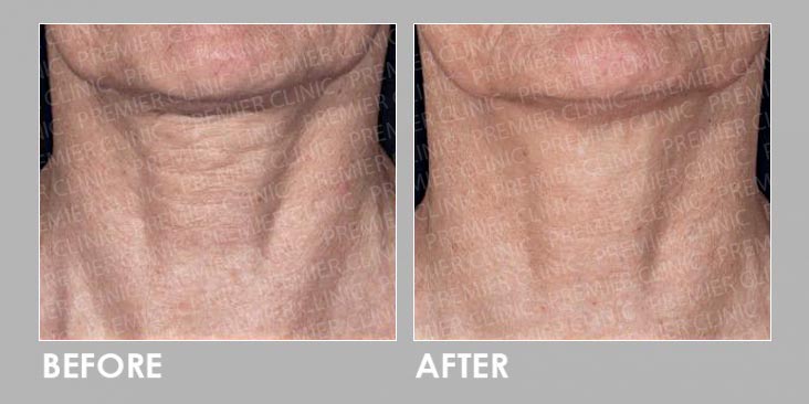 Before & After Potenza RF Micro-needling