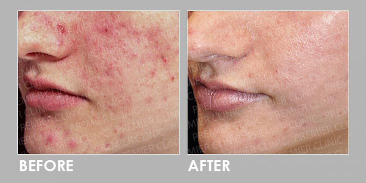 Before & After Potenza RF Micro-needling