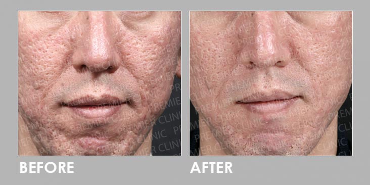 Before & After Potenza RF Micro-needling