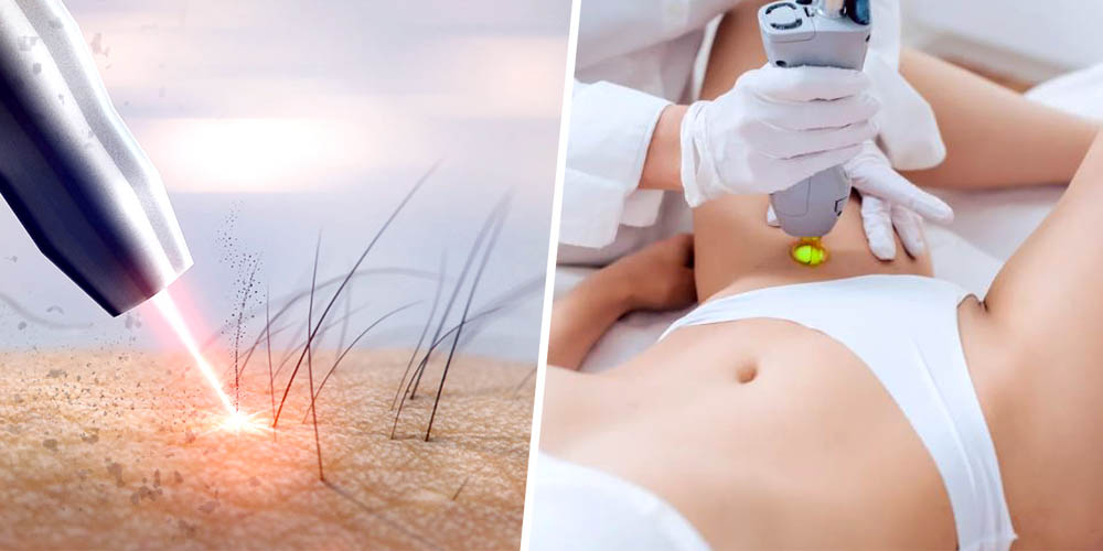 Brazilian Laser Hair Removal