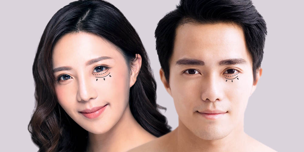 Eyebags removal with fotona laser