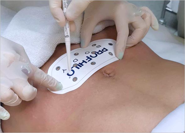 PROFHILO BODY