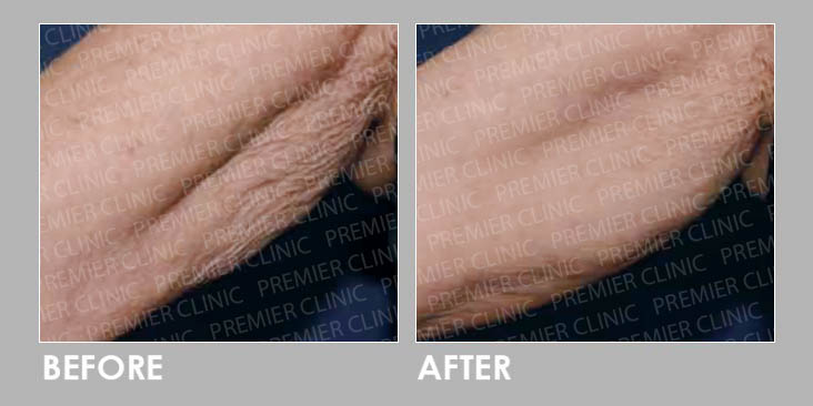 PROFHILO BODY Before After