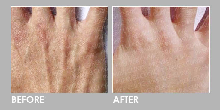 PROFHILO BODY Before After
