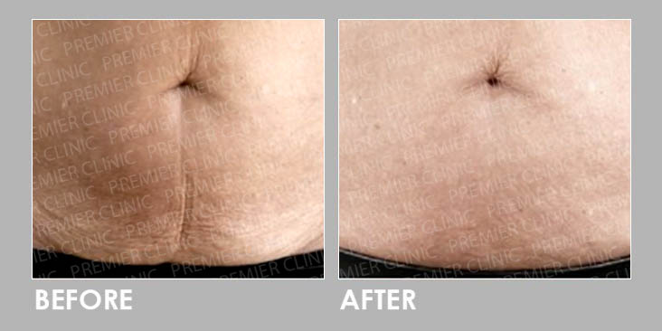 PROFHILO BODY Before After