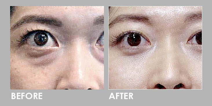 PuffyEye Relieve Before & After