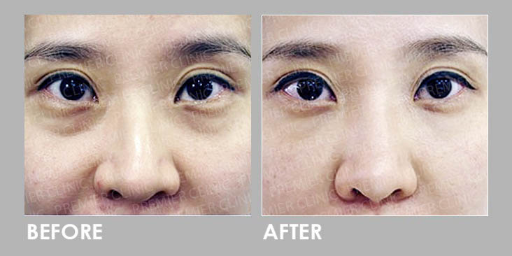 PuffyEye Relieve Before & After