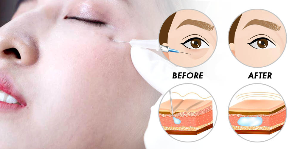 before and after eye filler injection treatment